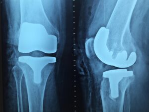 Oberarzt Orthopädie / Unfallchirurgie (Spezielle Orthopädische Chirurgie) - Region Leipzig/Halle (m/w/d)